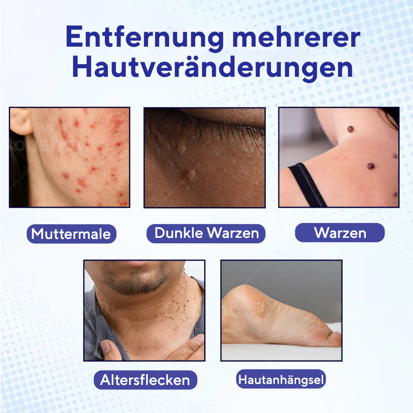 Fivfivgo® Warzen-Entferner Pro