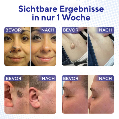 Fivfivgo® Warzen-Entferner Pro