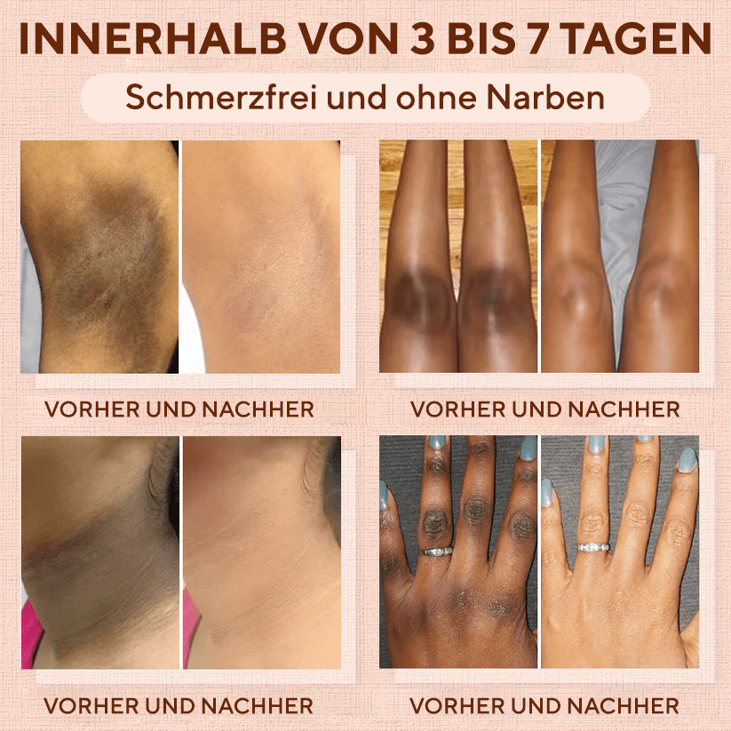Fivfivgo® Reinigendes Peeling-Gel für Acanthosis Nigricans, Peeling, dunkle Flecken, Hautflecken und Ekzeme