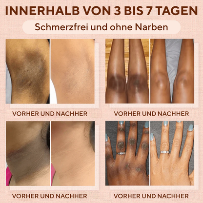 Fivfivgo® Reinigendes Peeling-Gel für Acanthosis Nigricans, Peeling, dunkle Flecken, Hautflecken und Ekzeme