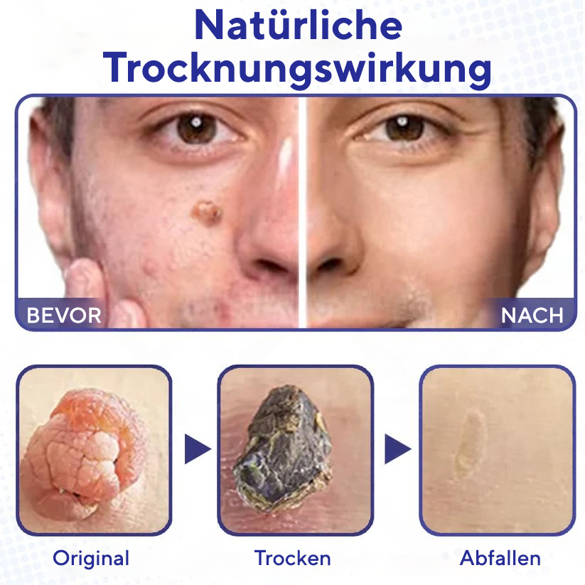 Fivfivgo® Warzen-Entferner Pro