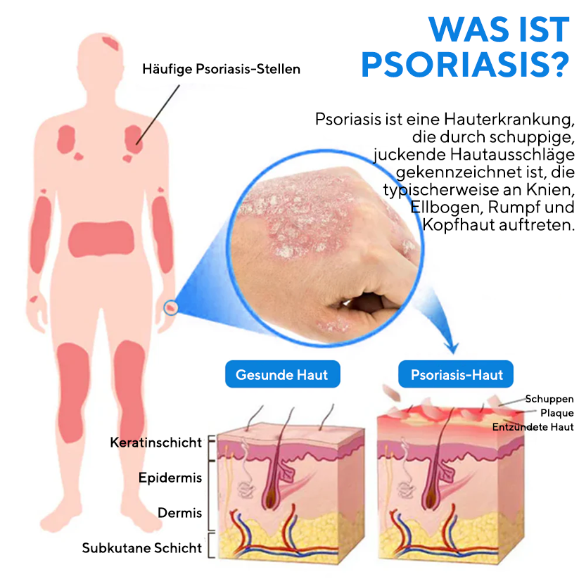 Fivfivgo® Magnesium-Kräuterspray gegen Psoriasis