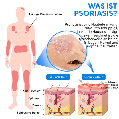 Fivfivgo® Magnesium-Kräuterspray gegen Psoriasis