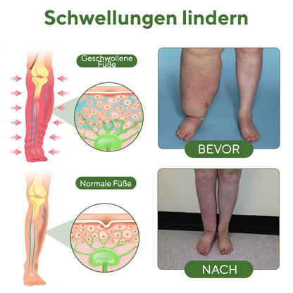 NovaRX® FluidEase Beintherapie-Ödemcreme