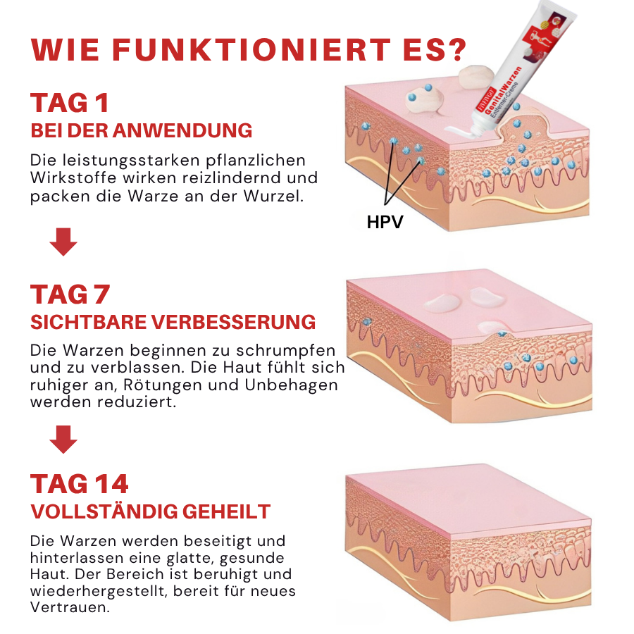 Fivfivgo® FloraGuard HPV Genitalwarzen-Entferner