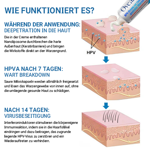 Oveallgo® HPV-Creme zur Linderung genitaler Warzen PRO