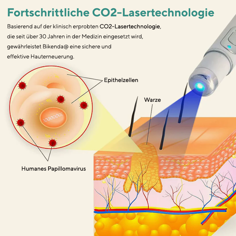 Bikenda® HPV Genitalwarzenentfernung Laserstift
