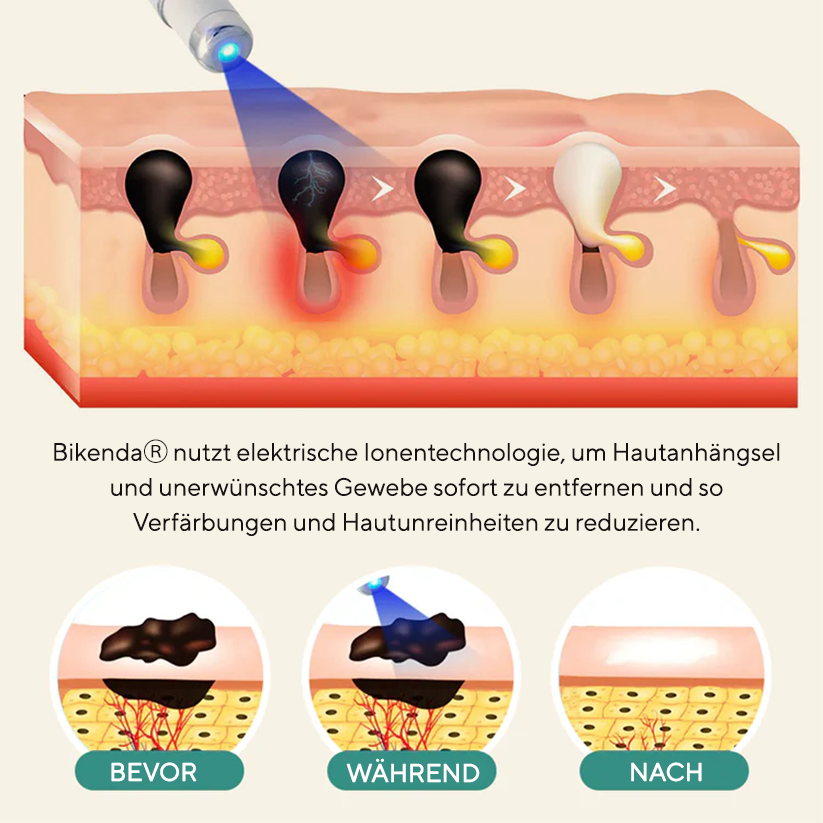 Bikenda® HPV Genitalwarzenentfernung Laserstift